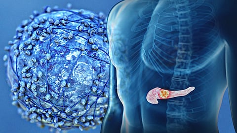 Small study reveals breakthrough potential for pancreatic cancer vaccine.