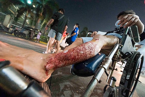 Painful lesson A leg injured by a firecracker blast, a man awaits treatment on New Year’s Eve on Sunday, one of 10 revelers brought in for pyrotechnic-related injuries at the Sta. Ana Hospital in Manila. | PHOTOGRAPH BY KING RODRIGUEZ FOR THE DAILY TRIBUNE