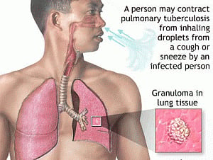 Origins of TB may lie in humans, not animals