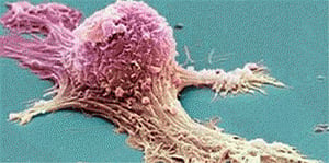 New gene linked to ovarian cancer discovered