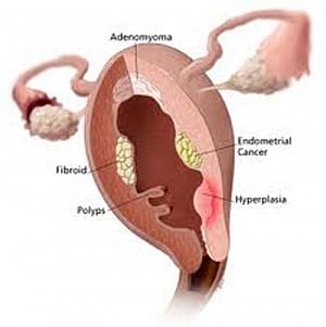Sugar-sweetened drinks may up uterine cancer risk in women
