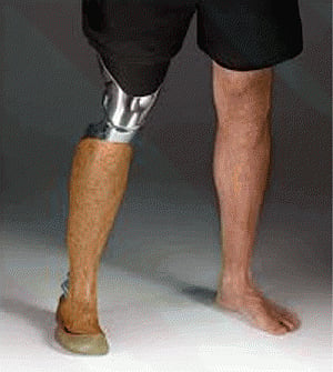 India to provide artificial limbs to 1000 people in Afghan