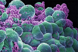 'New method of cancer treatment to be available in India soon'