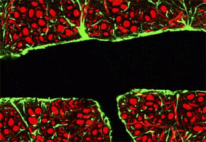 Blood-brain barrier breached for first time to treat cancer