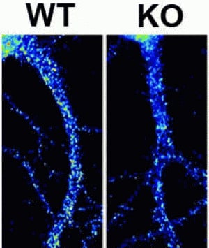 New genetic clues found in fragile X syndrome