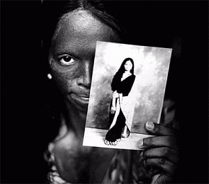 Acid attack victims to get free treatment