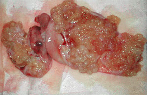 New test to help early diagnosis of ovarian cancer
