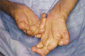 leprosy can be detected early: study