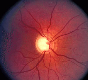 Glaucoma causes 1.3 lakh Indians to go blind every year: Doctors