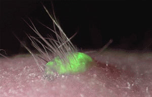 Artificial skin that grows hair could help burn victims