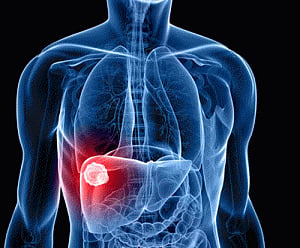 New tool can pinpoint life-threatening liver disease