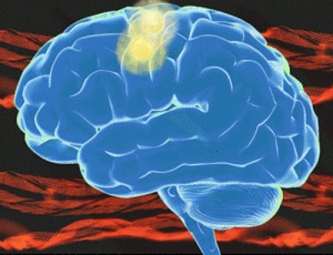 Reduced dosage of clot-busting drug can improve stroke treatment