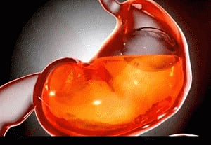 Gastric balloon pill found safe for weight loss