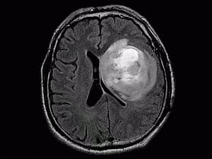 New hope for patients with deadly brain tumour