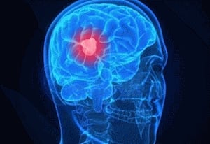 New way to treat aggressive brain tumour identified