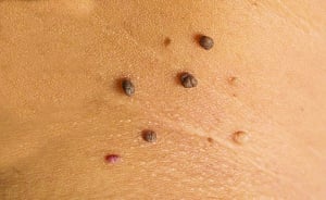 Docyard | Get rid of moles