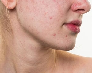 Acne stigma lowers quality of life: Study