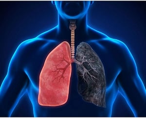 Breast cancer drugs may help treat resistant lung cancers
