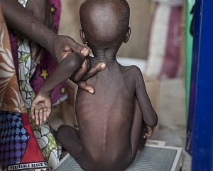 Focus on under-nutrition among children at meet on nutrition challenges