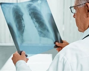 Many doctors in India miss TB signs: study