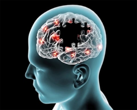 New AI tool can predict Alzheimer's risk