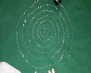 Chennai doctors extract 526 teeth from 7-year-old's mouth