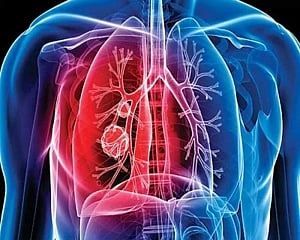 Quarter of global population at tuberculosis risk: Study