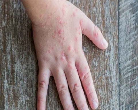 26 'tomato flu' cases in Odisha