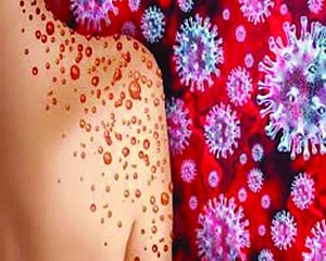 5th monkeypox case in Delhi, 22-yr-old has no travel history