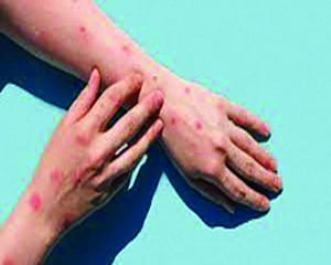 India reports its first Monkeypox death