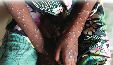 Mpox outbreak: 4 infected infants die in Pakistan