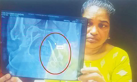 பெண்ணின் வயிற்றில் கத்திரிக்கோல் வைத்து தைத்த அரசு மருத்துவர்கள்- 5 ஆண்டுகளுக்கு பிறகு அம்பலம்