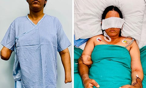 மருத்துவ உலகில் மற்றுமொரு அதிசயம்: இரு கைகளை இழந்த பெண்ணுக்கு கிடைத்த மறுவாழ்வு