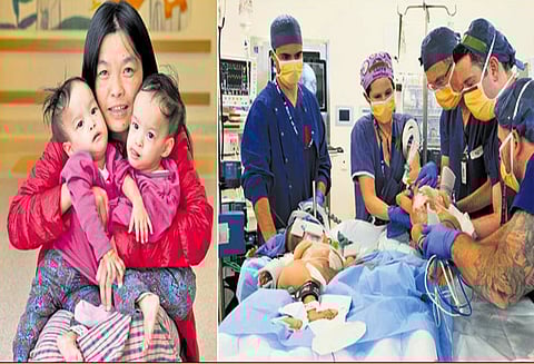 ஆஸ்திரேலிய ஆஸ்பத்திரியில் அறுவை சிகிச்சை: ஒட்டிப்பிறந்த இரட்டை குழந்தைகள் வெற்றிகரமாக பிரிக்கப்பட்டனர்