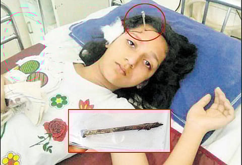 நாலச்சோப்ராவில் சிறுமியின் தலையில் புகுந்த ஆணி அறுவை சிகிச்சை மூலம் அகற்றம்