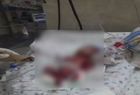 மருத்துவமனையில் இறந்துவிட்டது என பிளாஸ்டிக் பையில் கொடுக்கப்பட்ட குழந்தை உயிருடன் இருந்தது கண்டுபிடிப்பு