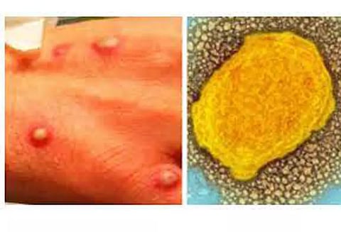 மும்பையில் குரங்கு காய்ச்சலுக்கு சிகிச்சை அளிக்க 28 படுக்கைகள்