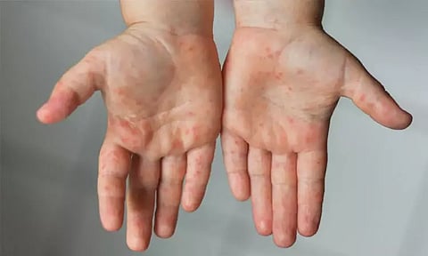 மும்பை: புதிதாக 30 பேருக்கு தட்டம்மை பாதிப்பு உறுதி; ஒருவர் உயிரிழப்பு