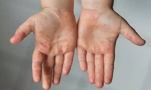 மும்பையில் புதிதாக 23 பேருக்கு தட்டம்மை பாதிப்பு உறுதி