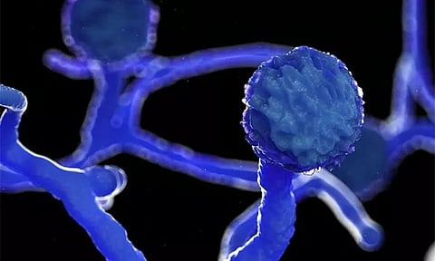 கொரோனா சிகிச்சை பெறும் நபருக்கு கருப்பு பூஞ்சை