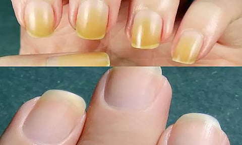 நகங்கள் மஞ்சள் நிறமாக மாறினால்..