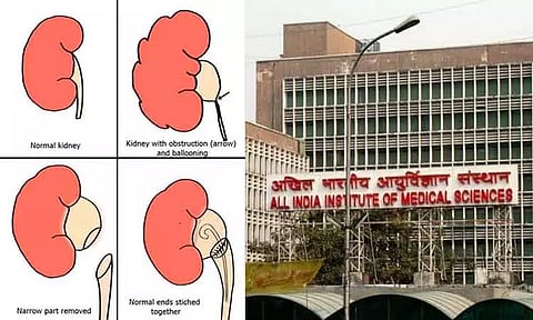 டெல்லி எய்ம்ஸ் மருத்துவமனையில் 3 மாத குழந்தைக்கு 'லேப்ராஸ்கோபிக்' ஆபரேஷன் - டாக்டர்கள் சாதனை