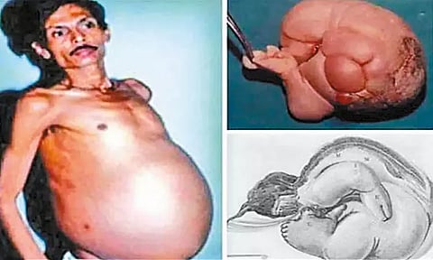 அரிய வகை நோயால் 36 ஆண்டுகளாக இரட்டை குழந்தைகளை வயிற்றில் சுமந்த தொழிலாளி