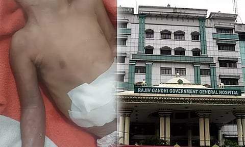 அரசு ஆஸ்பத்திரியில் குழந்தை கை இழந்த விவகாரம்: உயிரை காப்பாற்றவே கை அகற்றம்: மருத்துவ அறிக்கை வெளியீடு