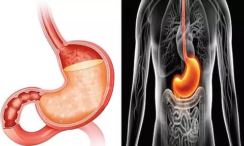 ஹைட்ரோகுளோரிக் அமிலம்-ஒரு பார்வை