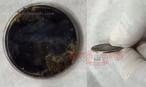 பொம்மையில் இருந்த பேட்டரியை விழுங்கிய 1 வயது பெண் குழந்தை