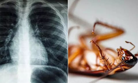 நோயாளியின் நுரையீரலில் 4 செ.மீ. கரப்பான் பூச்சி: உள்ளே நுழைந்தது எப்படி?