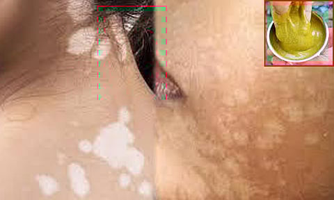 உடலில் உள்ள தேமல் நீங்க.... சித்த மருத்துவம்