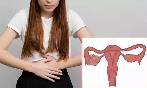 பெண்களை பாடாய்ப்படுத்தும் சினைப்பை நீர்க்கட்டிகள்.. சித்த மருத்துவத்தில் சிறந்த தீர்வுகள்