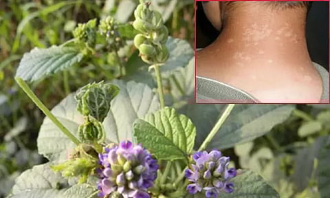 தோலில் தோன்றும் வெண் புள்ளிகள் நீங்க சித்த மருத்துவம்